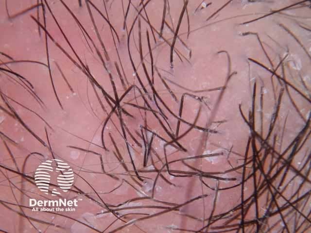 Dermoscopic image of tinea capitis showing zigzag hairs; focal weakening of the hair shaft in a male child