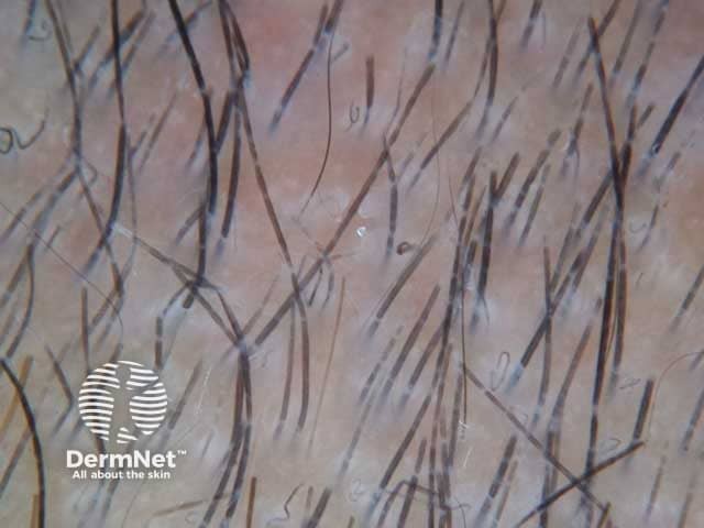 Dermoscopic image of tinea capitis showing morse code–like hair; interrupted hairs with multiple bands along the hair shaft in a female child.