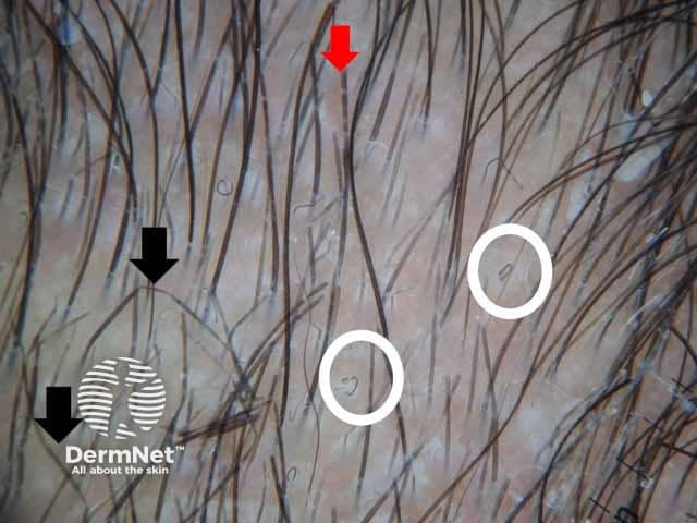 Dermoscopic image showing comma hair (white circles) zigzag hair (black arrows) and morse-code hair (red arrows) denoting tinea capitis