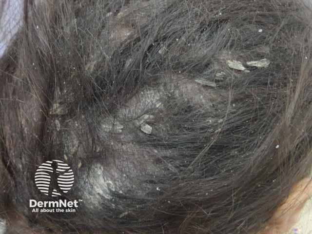 Tinea Capitis Images — DermNet