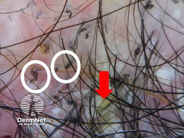 Dermoscopic image of corkscrew hairs (white circles) with yellowish greasy scales (red arrows) denoting tinea capitis