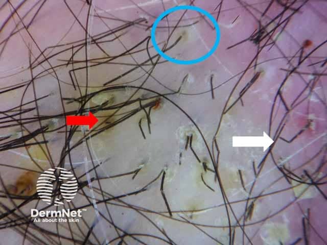 Dermoscopic image showing zigzag hairs (white arrow) with yellowish crustations (red arrows) and follicular pustule (blue circle) denoting inflammatory type tinea capitis