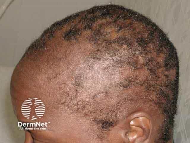 Resolving tinea capitis after oral griseofulvin treatment