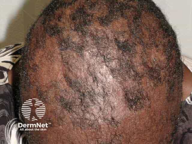 Resolving tinea capitis after griseofulvin treatment