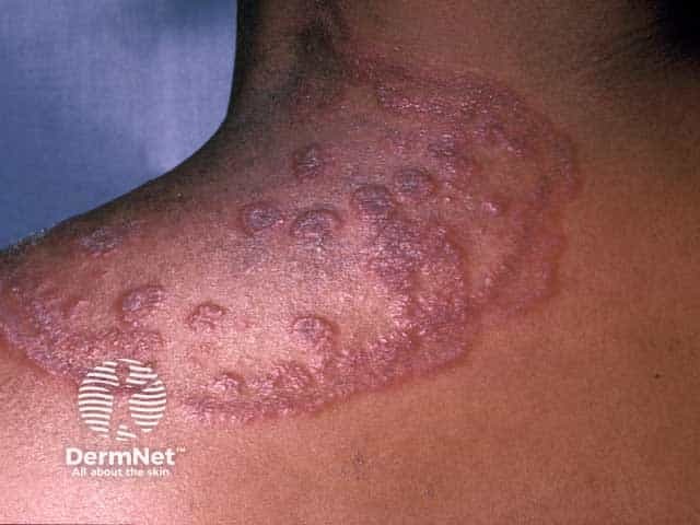 Tinea circinata of the shoulder in HIV infection