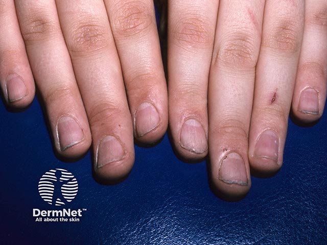 Rough, ridged, and split nails due to twenty nail dystrophy