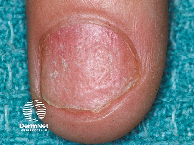 Rough longitudinally-pitted nail due to twenty nail dystrophy