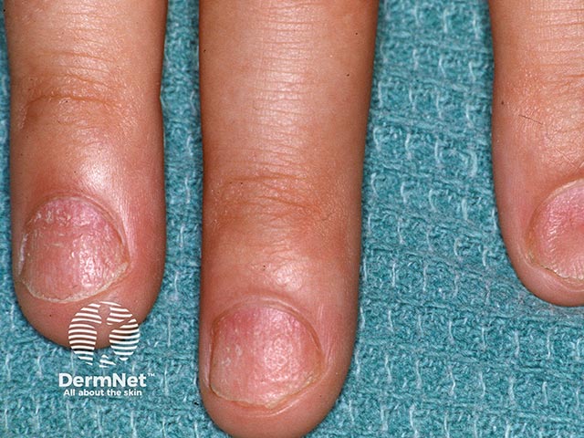 Rough nails with longitudinal pits due to twenty nail dystrophy