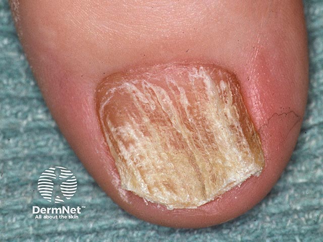Severe ridging and dystrophy of the nail plate in twenty nail dystrophy