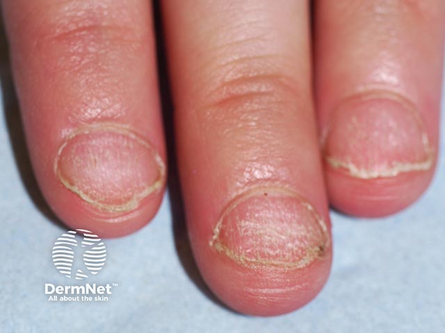Rough nail plates (trachyonychia) in twenty nail dystrophy