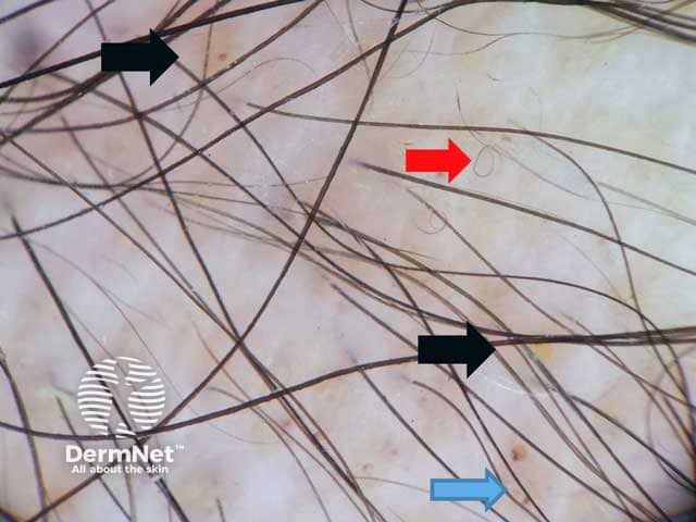 Dermoscopic image showing reduced hair density, yellow dots (Black arrows), regrowing hair (red arrows) and extravasated blood (Blue arrow) denoting tractional alopecia