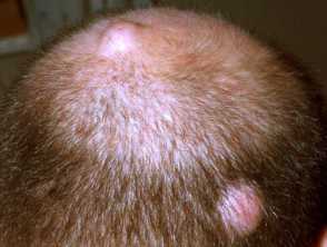 Scalp Tumours and Cysts: A Complete Overview - DermNet