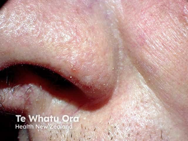 Small trichilemmal cyst nasal rim