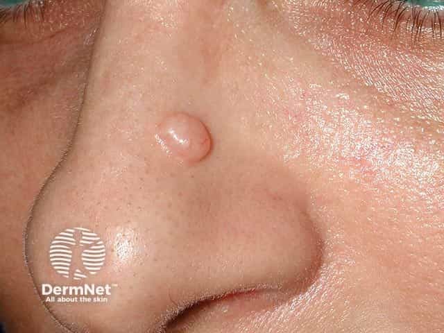 A solitary trichoepithelioma on the nose