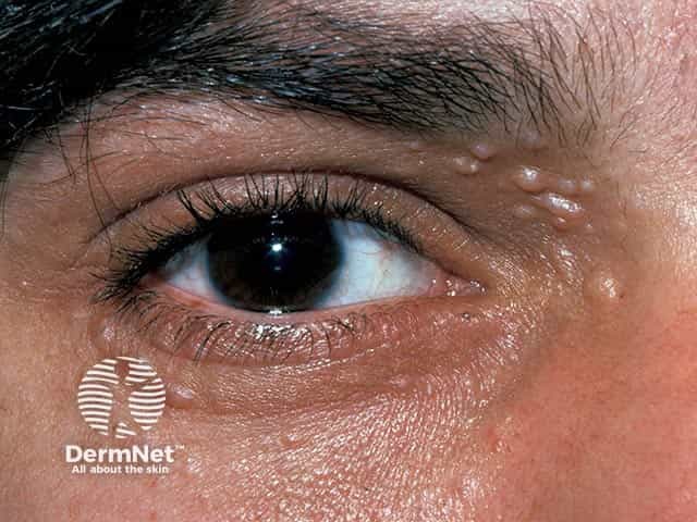 Multiple symmetrical 3-4mm flesh-coloured  periocular papules due to familial trichoepithelioma