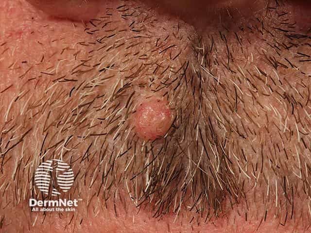 A solitary trichoepithelioma on the lip