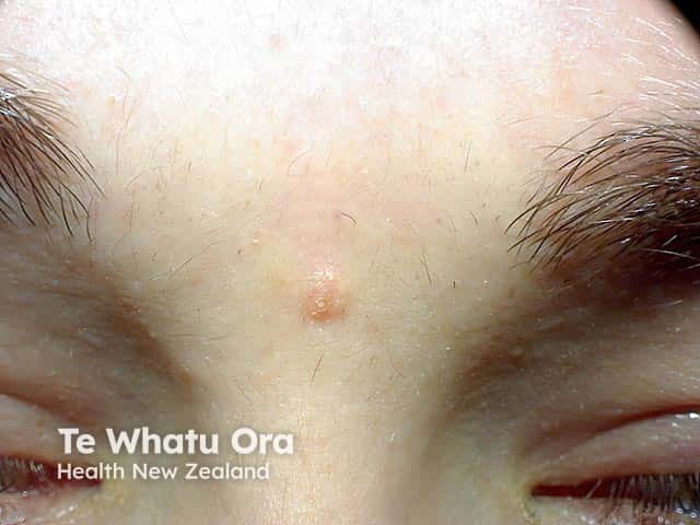 A solitary trichoepithelioma on the glabella