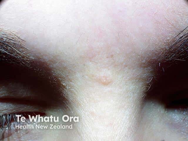Solitary trichoepithelioma on the brow