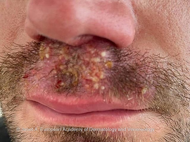 A kerion-like lesion in the beard area due to T mentagrophytes type VII