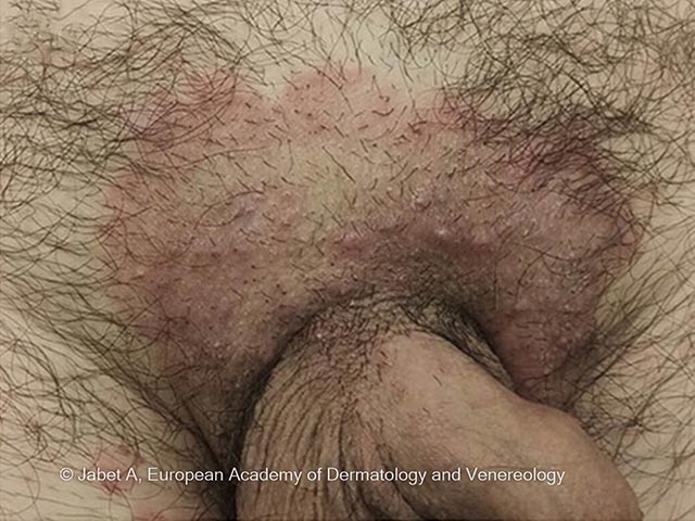 A well-circumscribed red scaly patch in the groin - mycology was positive for T mentagrophytes type VII