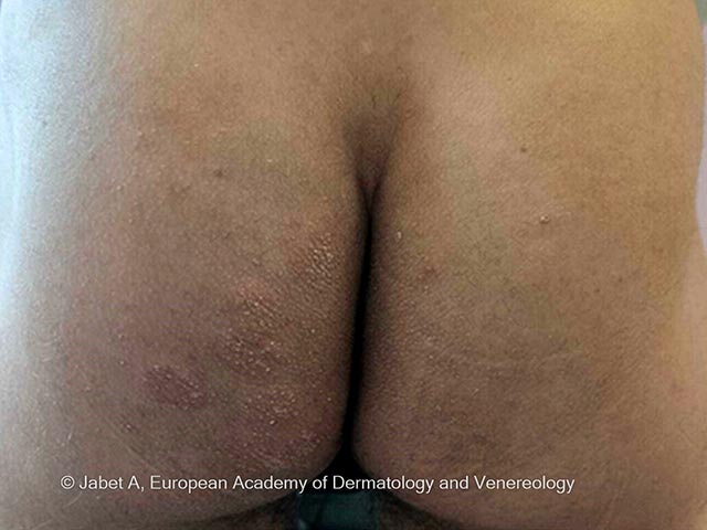 Red scaly circinate plaques on the left buttock due to T mentagrophytes type VII