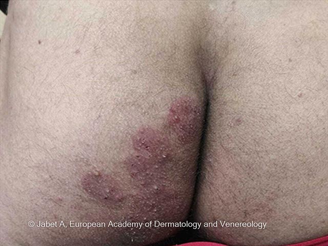 A unilateral scaly patch on the buttock due to T mentagrophytes type VII