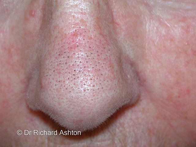 Comedo-like lesions due to nasal TS