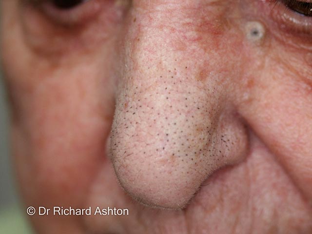 Trichostasis spinulosa on the nose - multiple hairs emanate from a single follicle