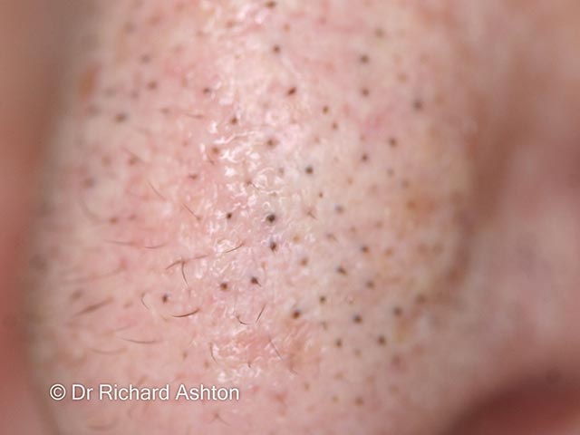 Trichostasis spinulosa on the nose - multiple hairs emanate from a single follicle