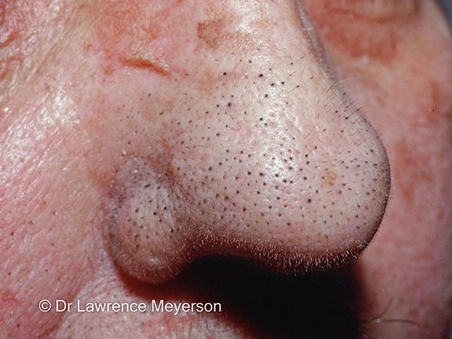 TS on the nose - multiple hairs emanate from each follicle