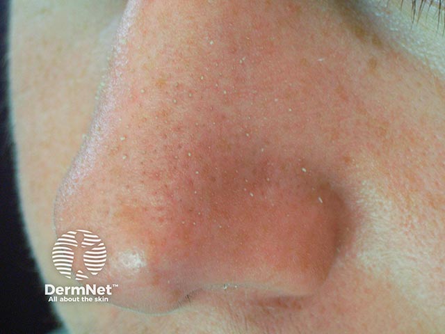 Trichostasis spinulosa on the nose - multiple hairs emanate from a single follicle