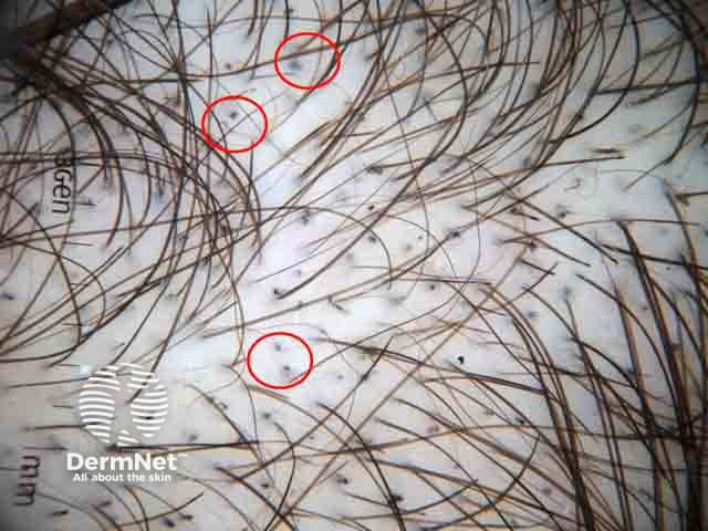 Trichotillomania showing black dots; follicular openings with remnants of pigmented hairs broken at scalp level