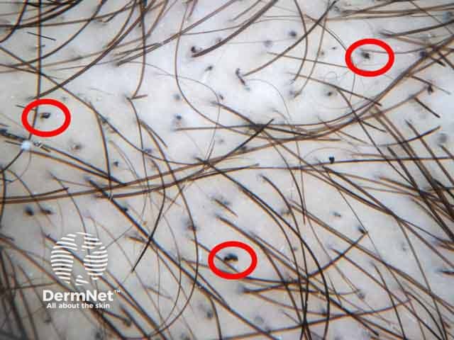 Dermoscopic image of trichotillomania showing flame figures; hair remnants of recently pulled hairs
