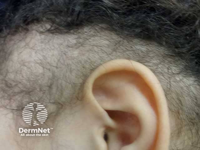 Short remnant hairs seen over the ears in trichotillomania