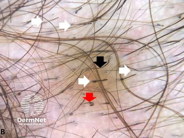 Dermoscopic image showing hair cut at different levels (white arrows), hook hair (black arrows) and flame figures (red arrows) denoting trichotillomania