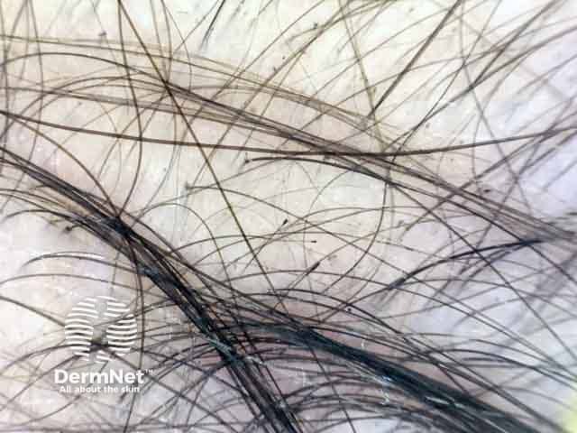 Dermoscopic image showing tulip hair