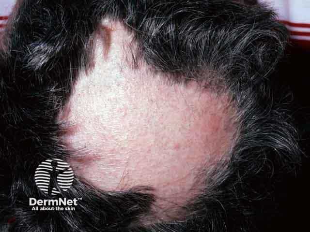 Trichotillomania over the scalp vertex