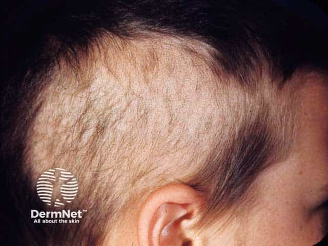 Short remnant hairs seen in trichotillomania