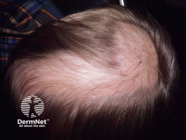 Extensive trichotillomaia over the crown and vertex of the scalp