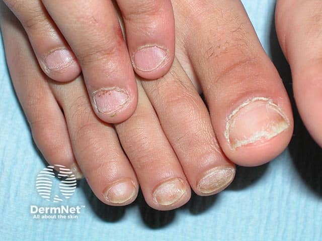 Rough longitudinally-ridged fingernails and toenails due to twenty nail dystrophy