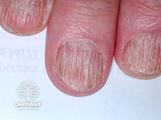 Rough longitudinally-ridged fingernails due to twenty nail dystrophy