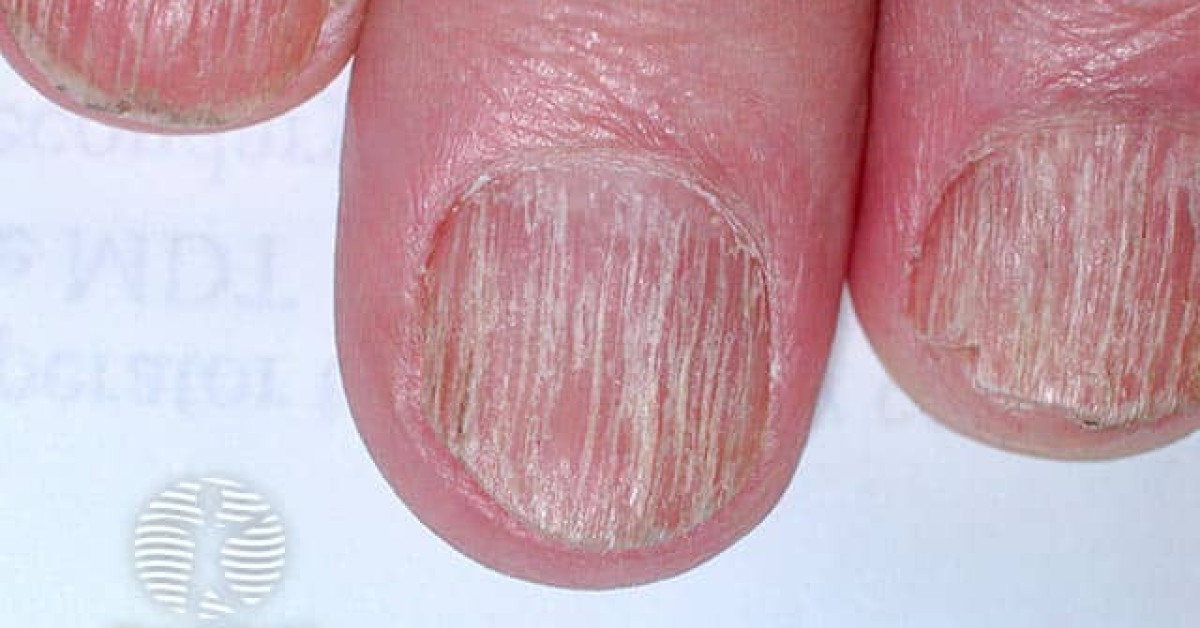 DermNet® - Twenty nail dystrophy image