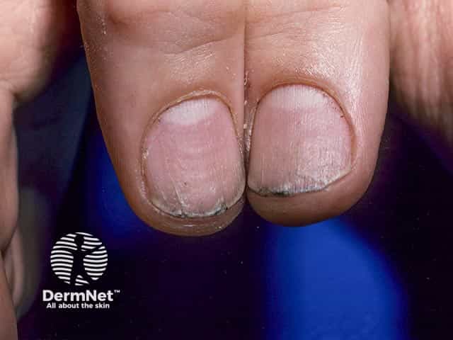 Rough longitudinally-ridged thumb nails with splitting of the free edge due to twenty nail dystrophy