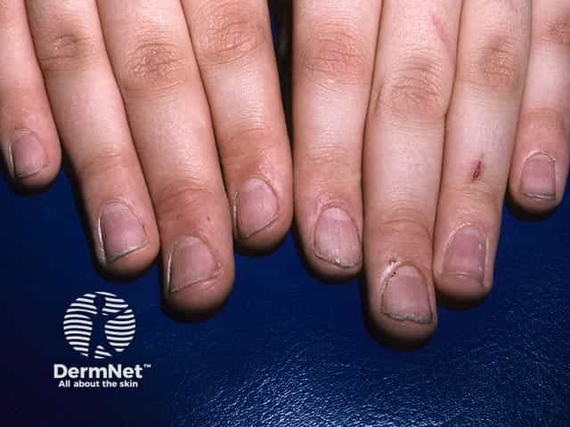 Rough, ridged, and split nails due to twenty nail dystrophy
