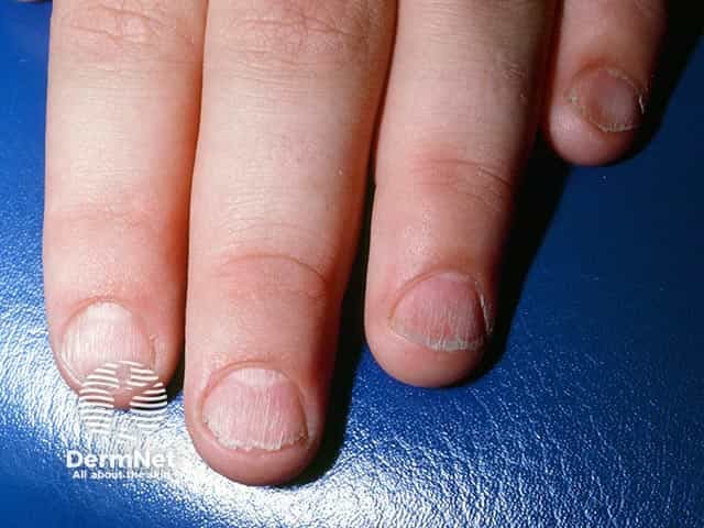 Rough ridged nails with split free edges due to twenty nail dystrophy
