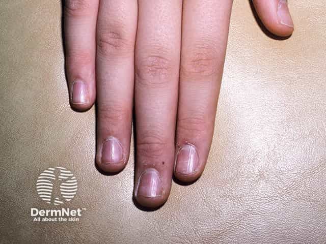 Dull, rough, ridged nails due to twenty nail dystrophy