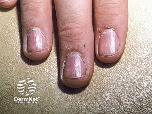 Superficial longitudinal ridges in twenty nail dystrophy