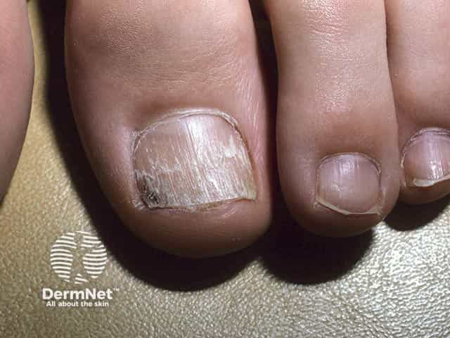Rough ridged nail with onychoschizia in twenty nail dystrophy