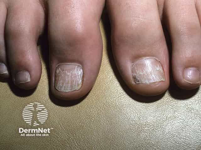 Rough ridged nails with onychoschizia in twenty nail dystrophy