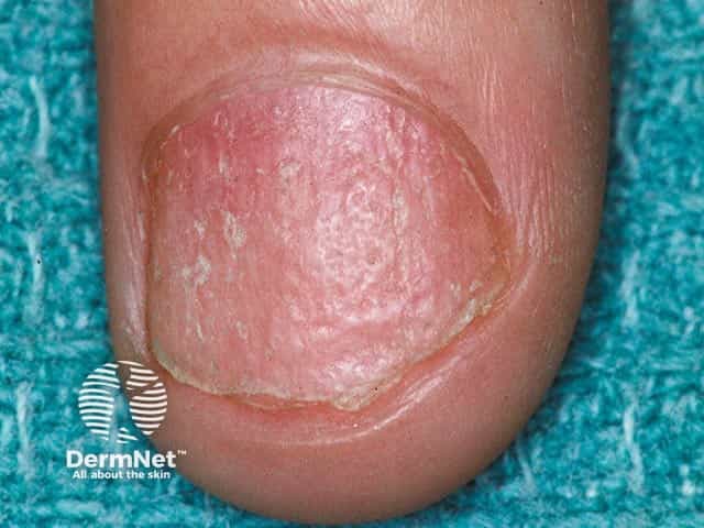 Rough longitudinally-pitted nail due to twenty nail dystrophy